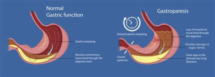 What causes gastroparesis flare?