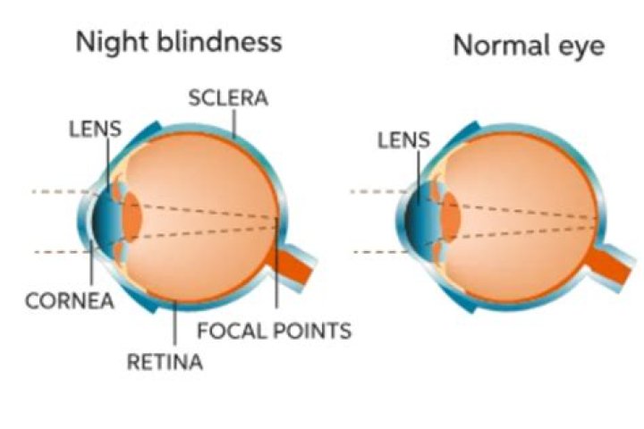 What causes night blindness?