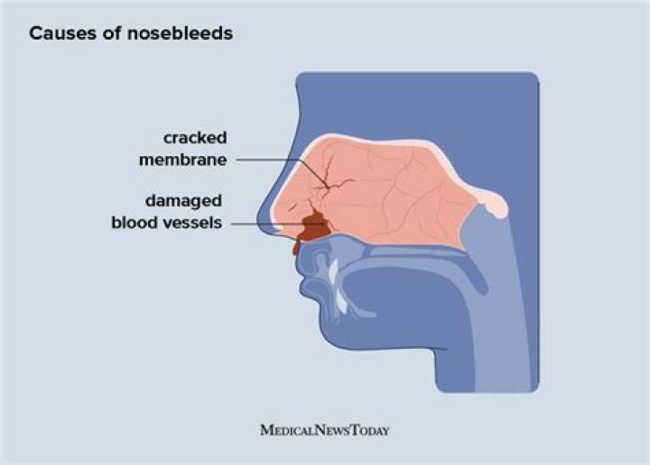 What causes nosebleeds with large clots?