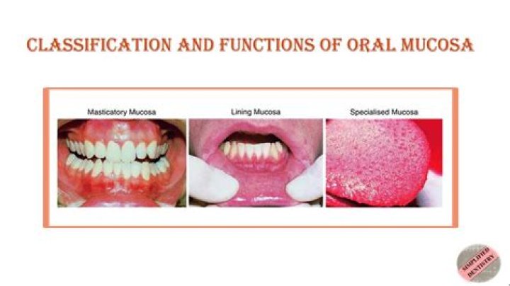 What causes oral mucosa?