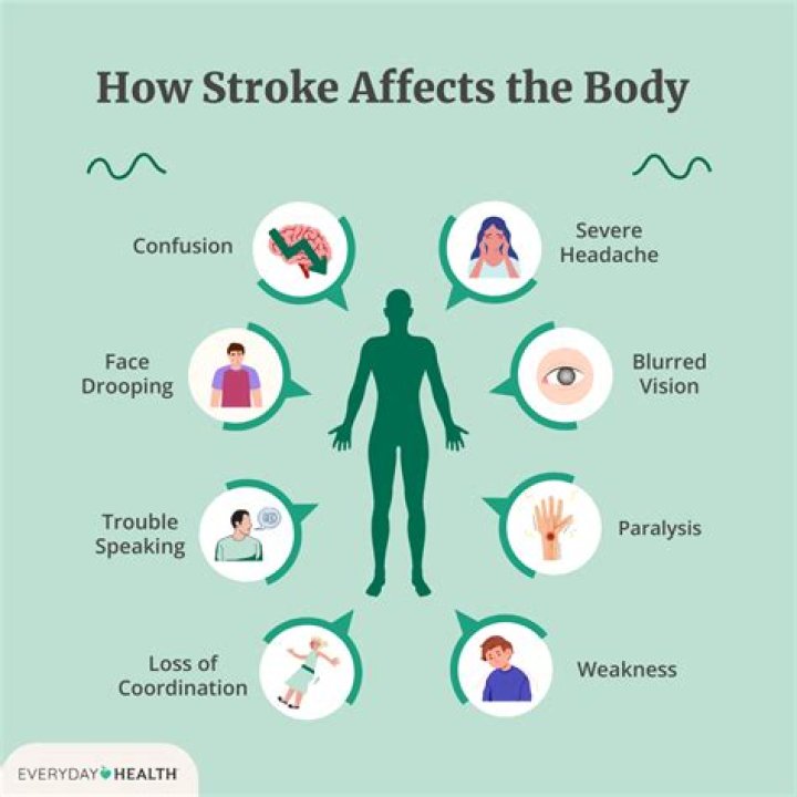 What causes stroke like symptoms but is not a stroke?