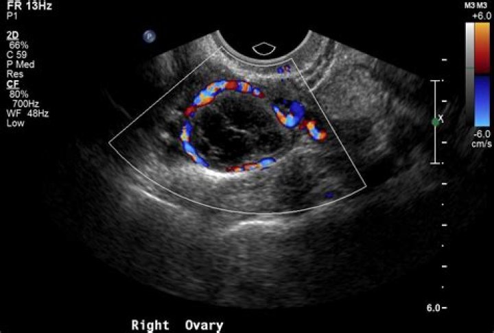 What color are tumors on an ultrasound?