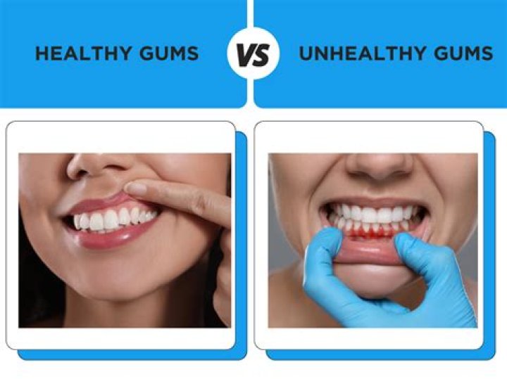 What color are unhealthy gums?