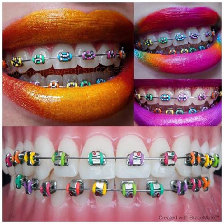 What color braces are most attractive?