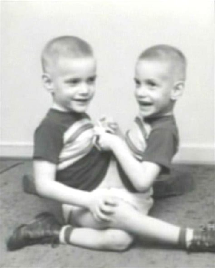 What did the conjoined twins Ronnie and Donnie died from?