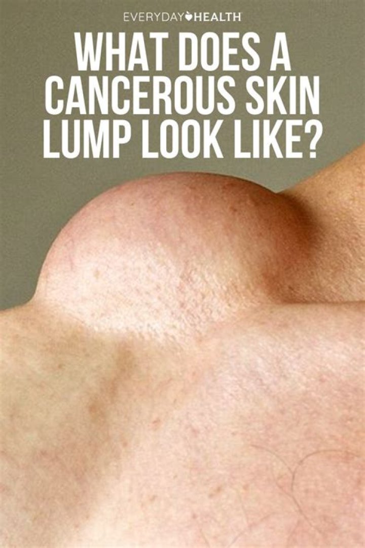 What do cancerous lumps look like?