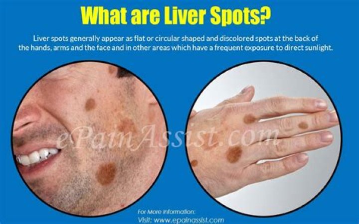 What do liver spots look like?