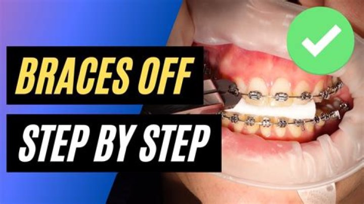What do orthodontists do when taking braces off?