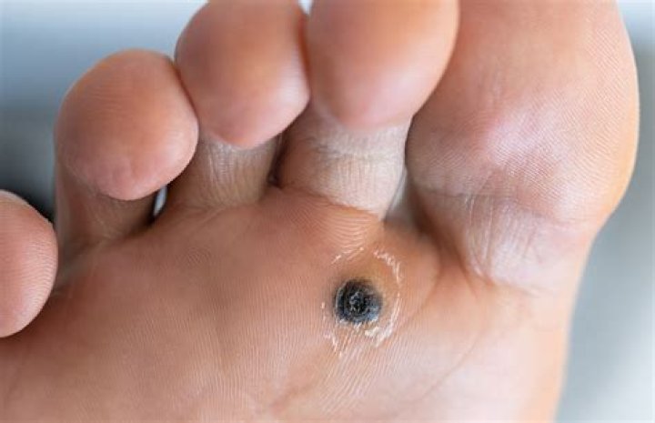 What do plantar warts look like?