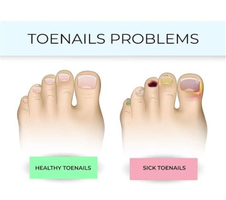 What do your toenails say about your health?