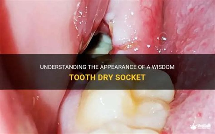 What does a dry socket look like?