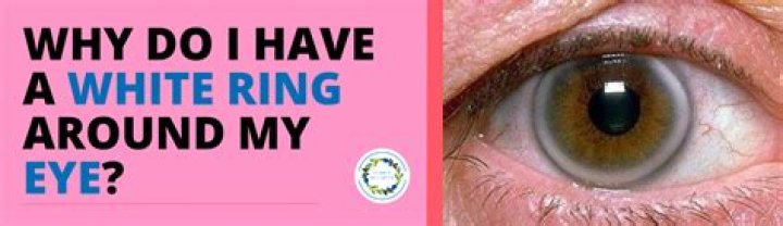 What does a white ring around your eye mean?