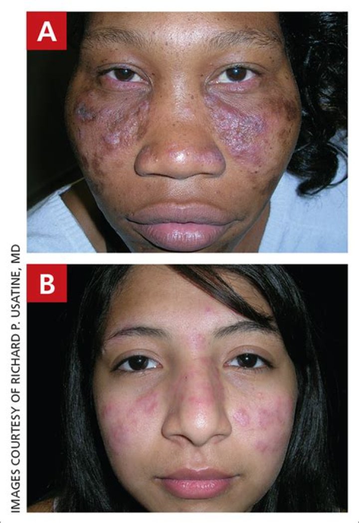 What does discoid lupus look like?