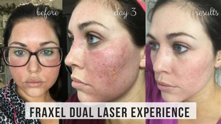 What does Fraxel do to your face?