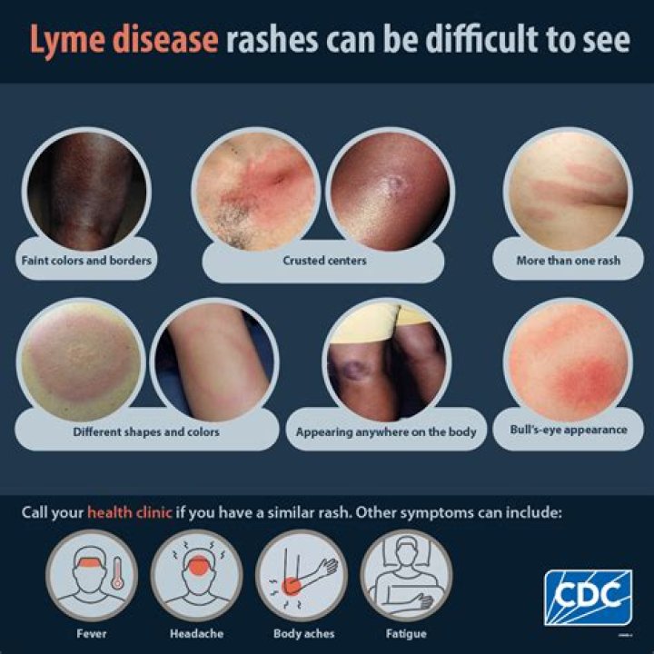 What does Lyme disease look like?