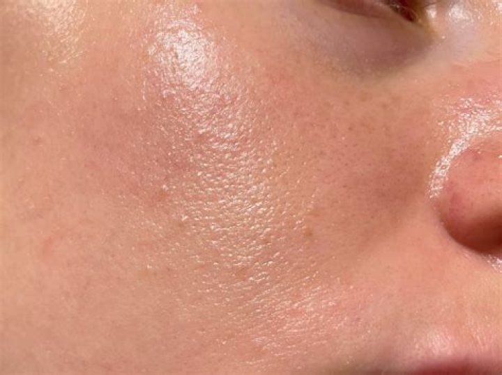 What does oily skin look like?