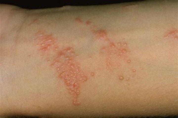What does poison ivy look like on your skin?