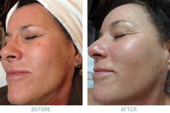 What does your face look like after microdermabrasion?