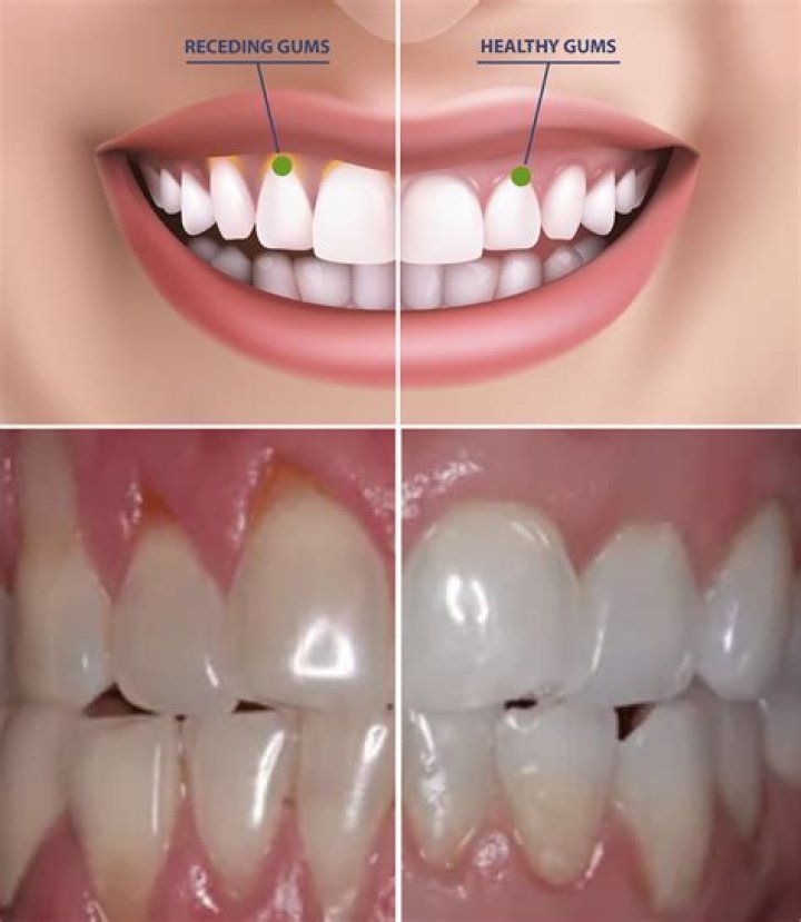 What foods help receding gums?