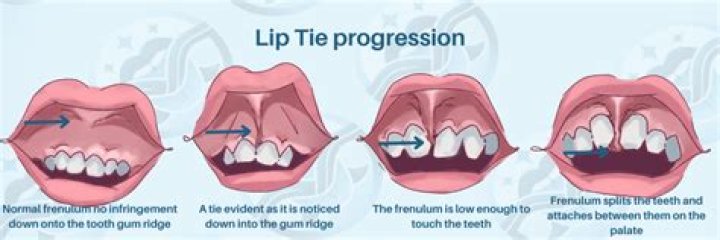 What happens after tongue-tie release in adults?