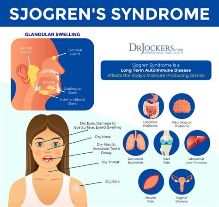 What happens if Sjogren's goes untreated?