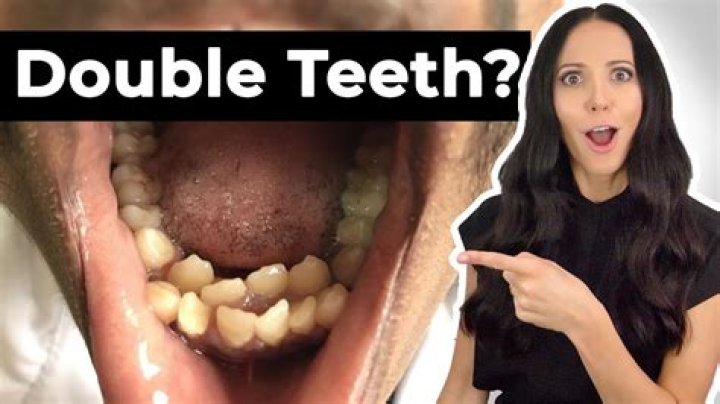 What happens if you have an extra tooth?