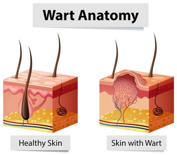 What happens if you pick a wart?