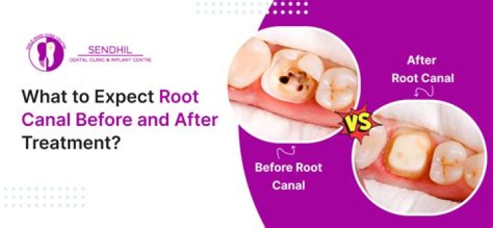 What happens to a molar after a root canal?