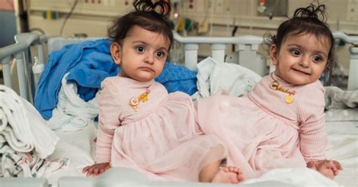 What happens when one of the Hensel twins dies?