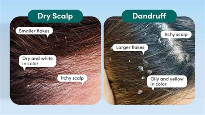 What if dandruff is left untreated?