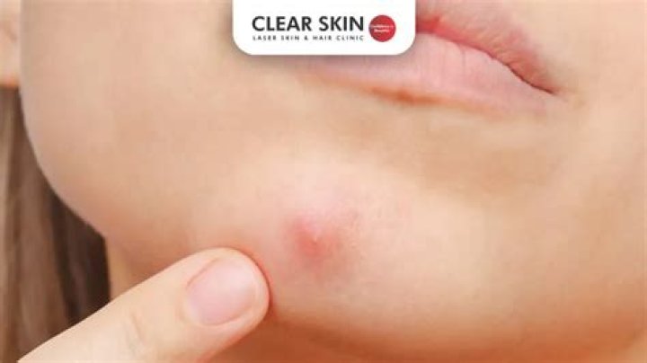 What is a blind pimple?