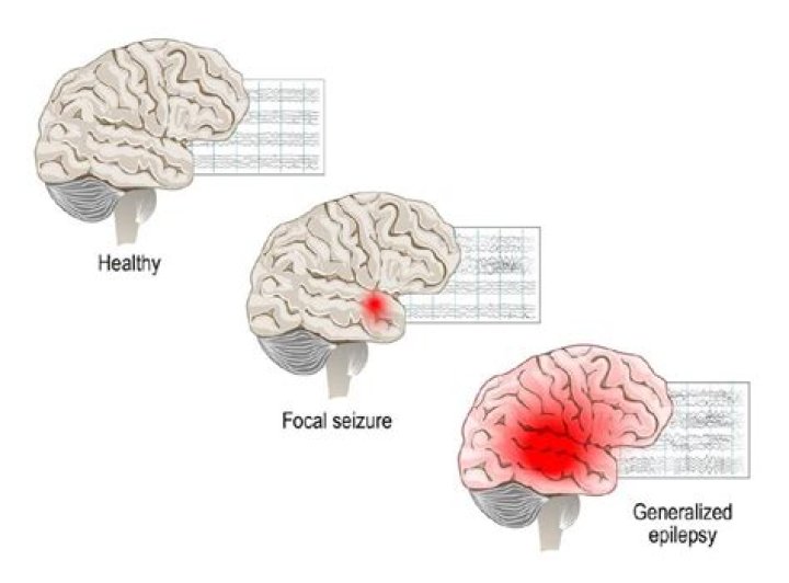What is a focal seizure?