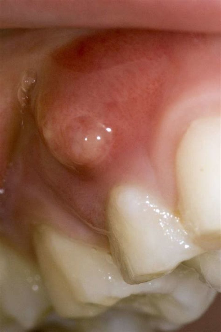 What is a gum cyst?