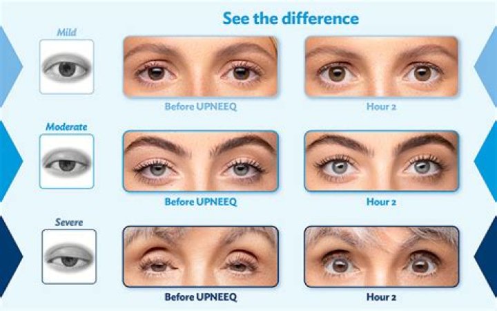 What is best for saggy eyelids?