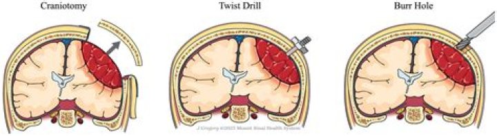 What is considered a late postoperative complication following craniotomy?