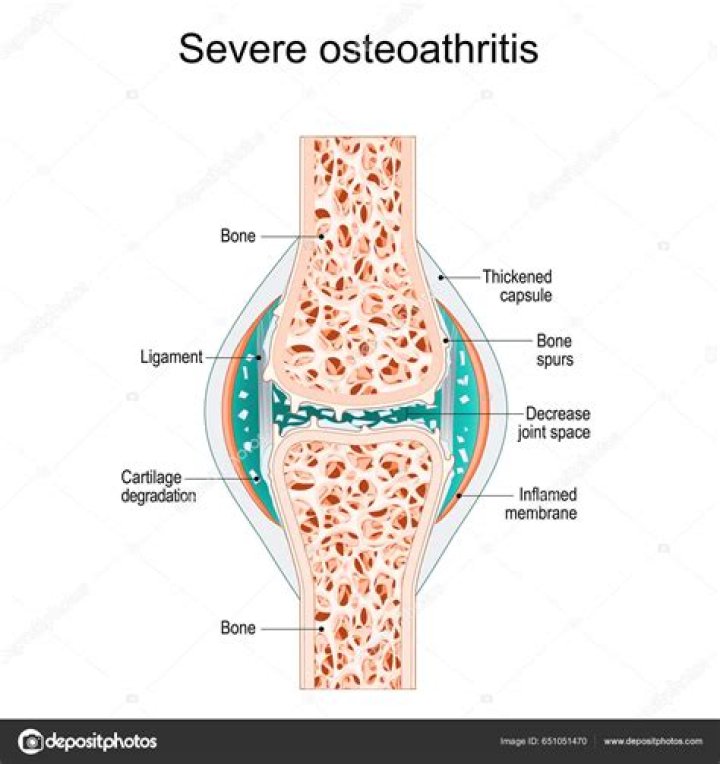 What is considered severe osteoarthritis?