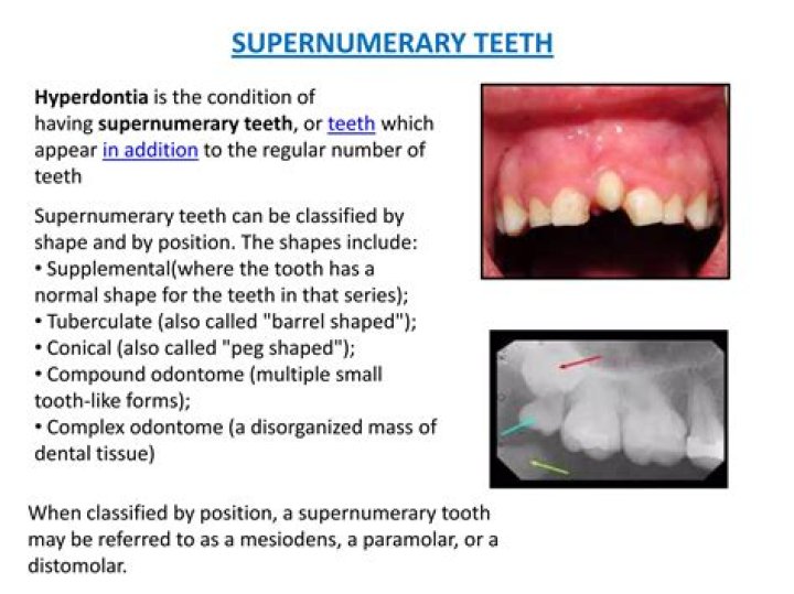 What is difference between hyperdontia and supernumerary?