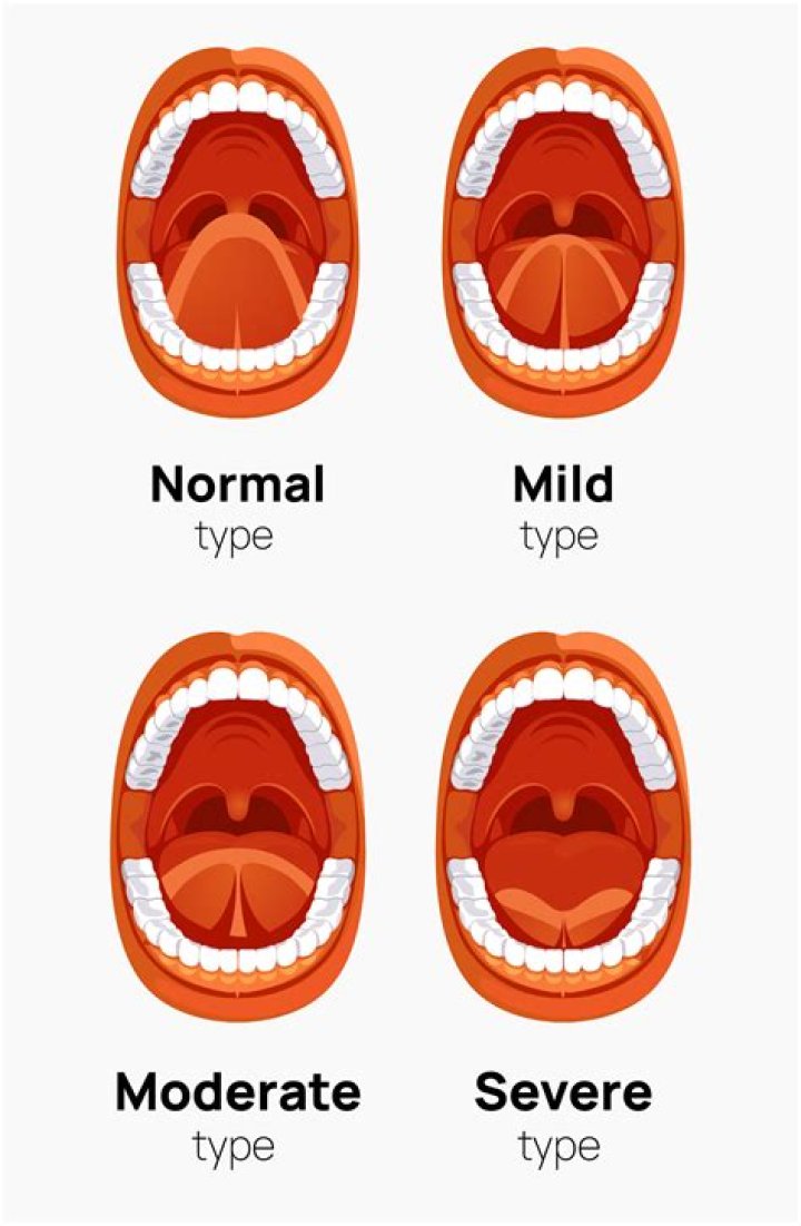 What is mild tongue-tie?