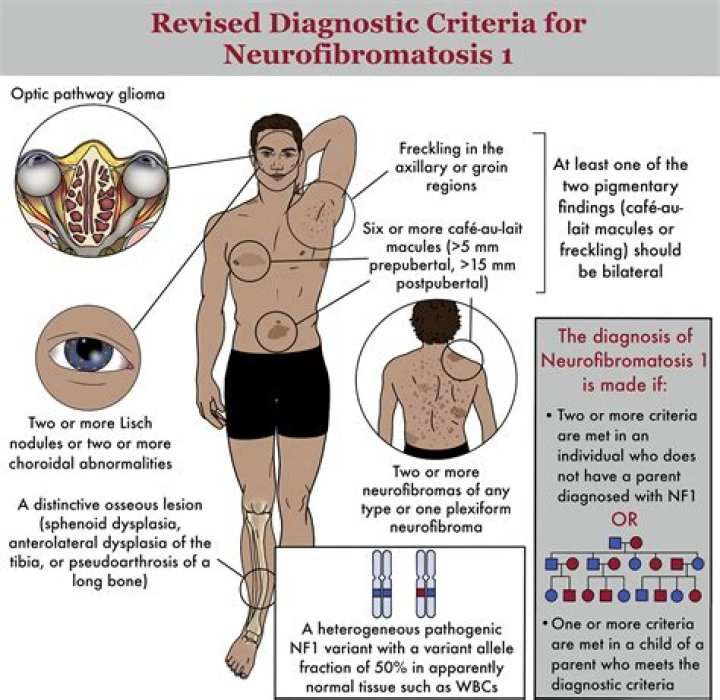 What is Neurofibrosis?