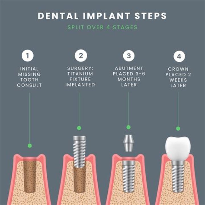 What is recovery like after dental implants?