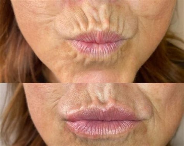 What is the best filler for upper lip wrinkles?