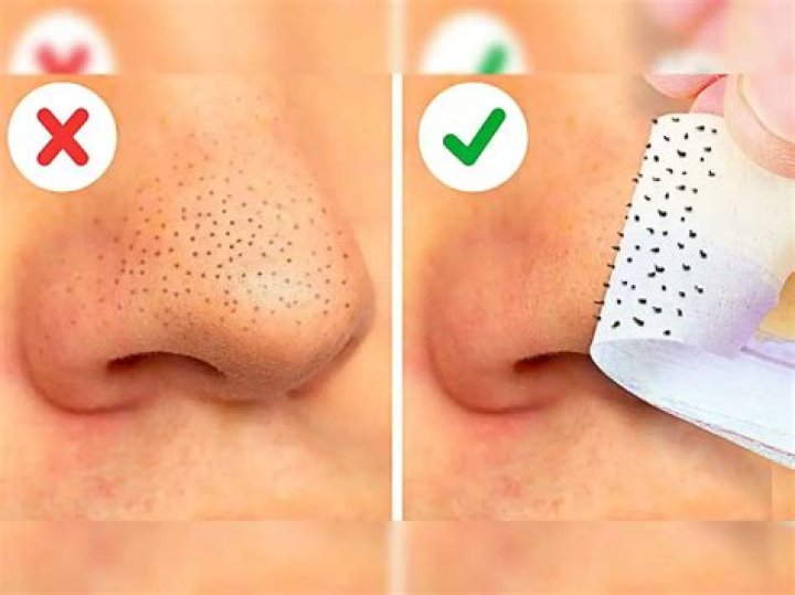 What is the black part of a blackhead?