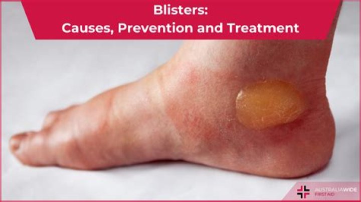 What is the liquid in a burn blister?