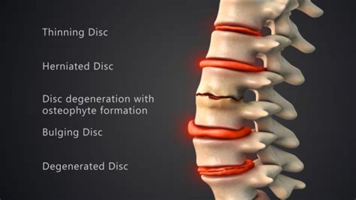 What is the long term prognosis for degenerative disc disease?