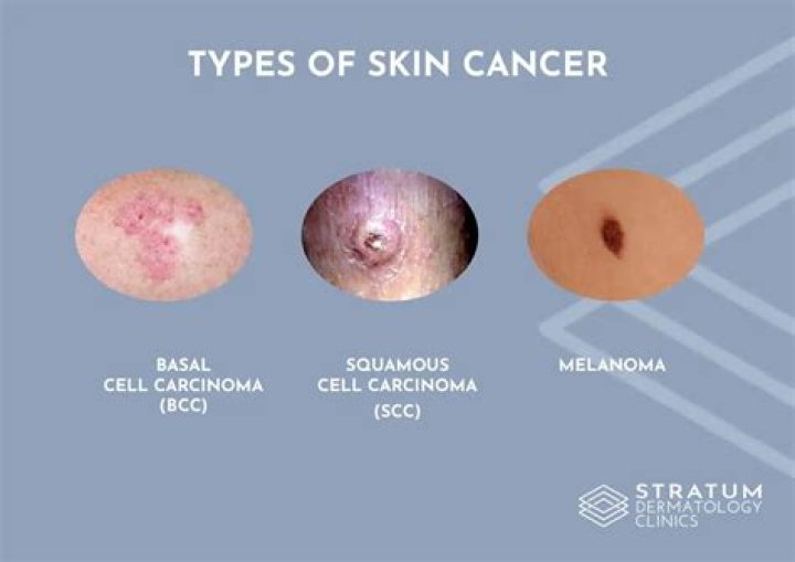 What is the most common skin type?