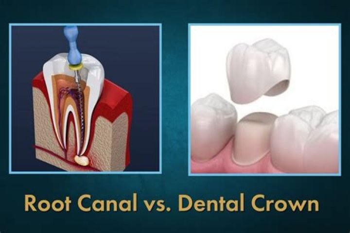 What is worse a crown or root canal?