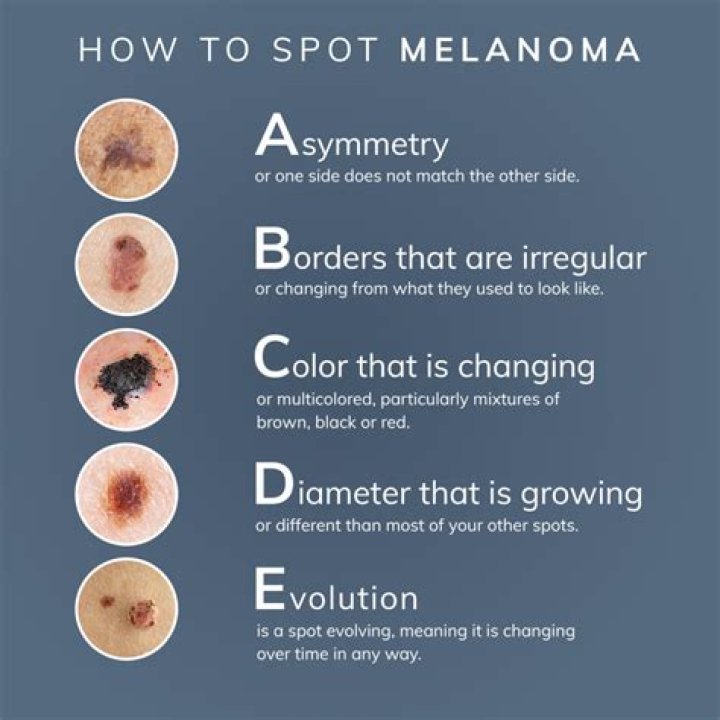 What kills melanoma?