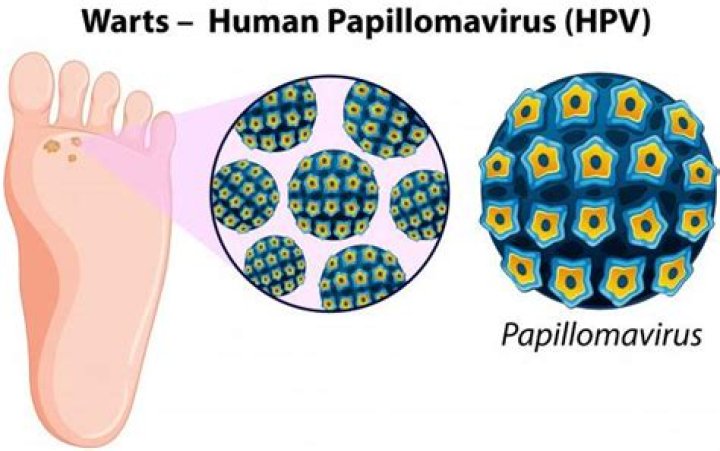 What kills the wart virus?