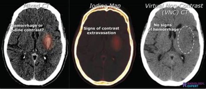What kind of side effects we can have when we use CT contrast?
