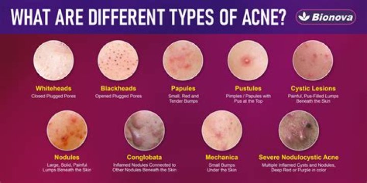 What percent of the world has acne?
